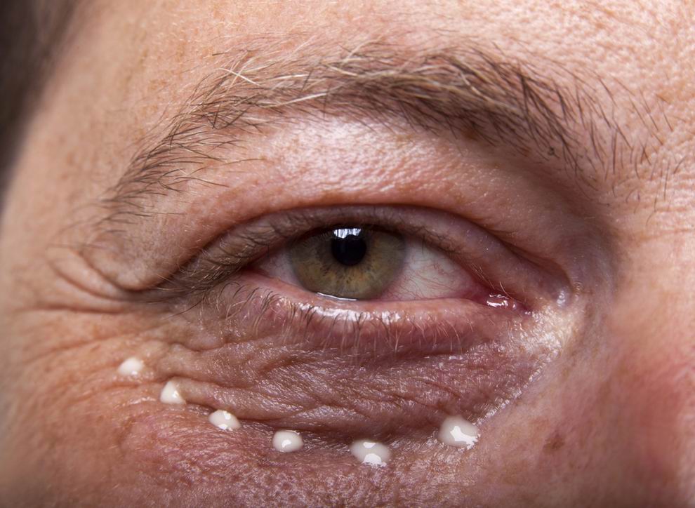 szem alatti sötét karikák eltüntetése